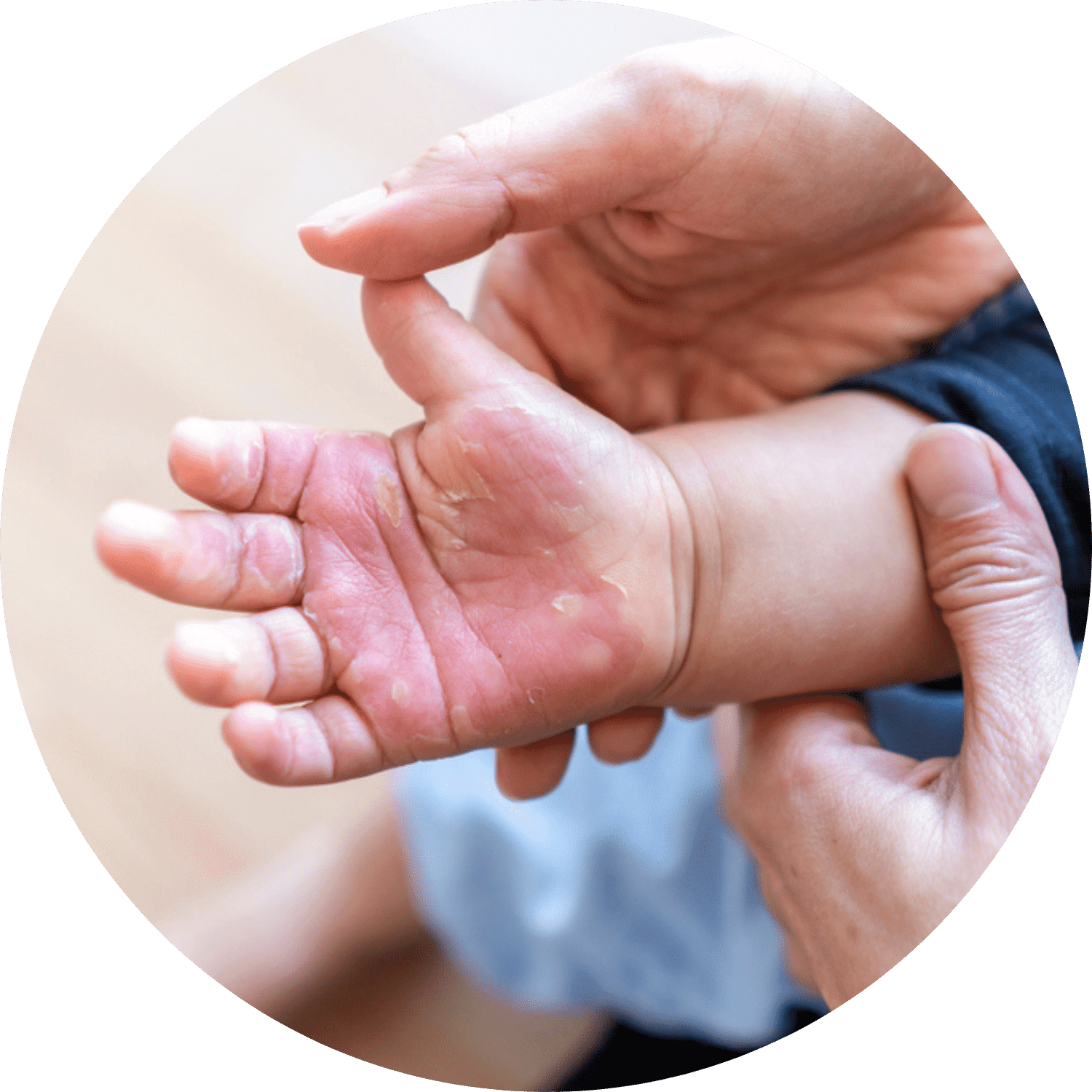 burn injury
