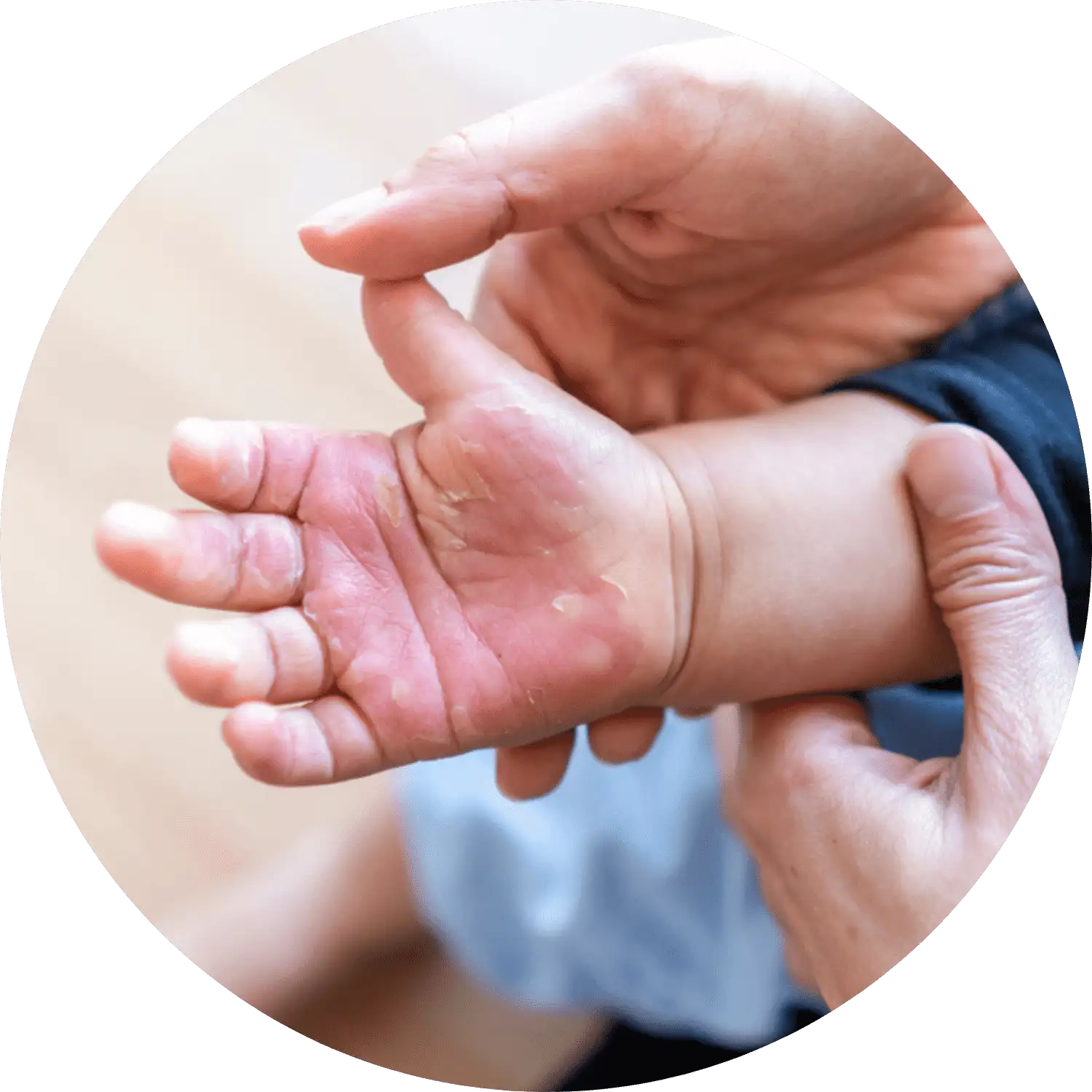 New York Burn Injury Attorney